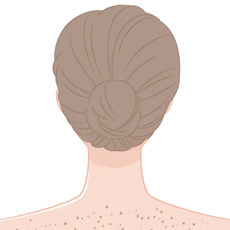 光線性花弁状色素斑