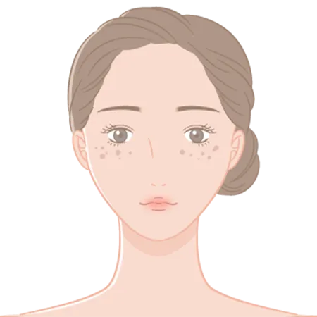 後天性真皮メラノサイトーシス（ADM）